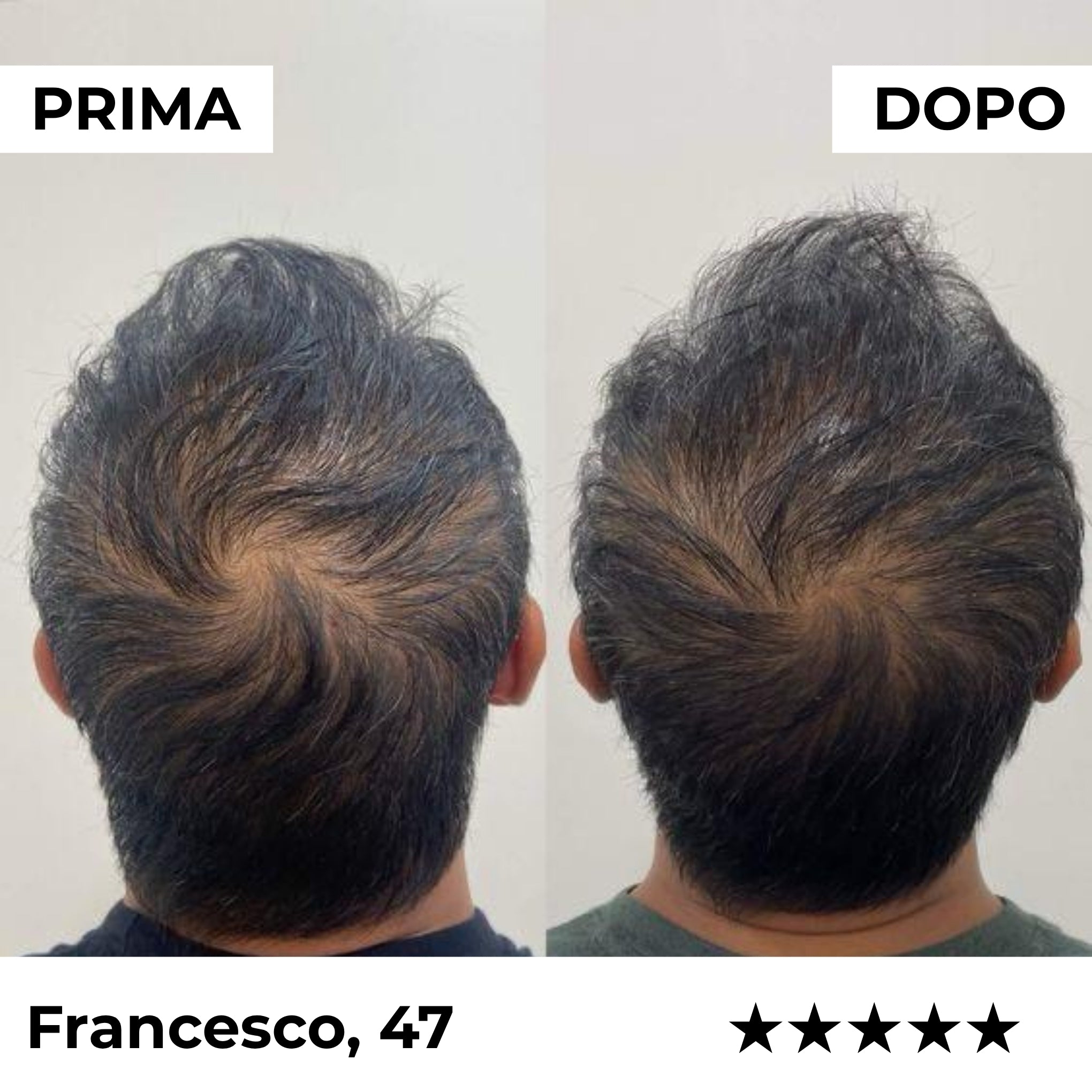 System Mikroinfuzji Kapilarnej Firmelià PRO®