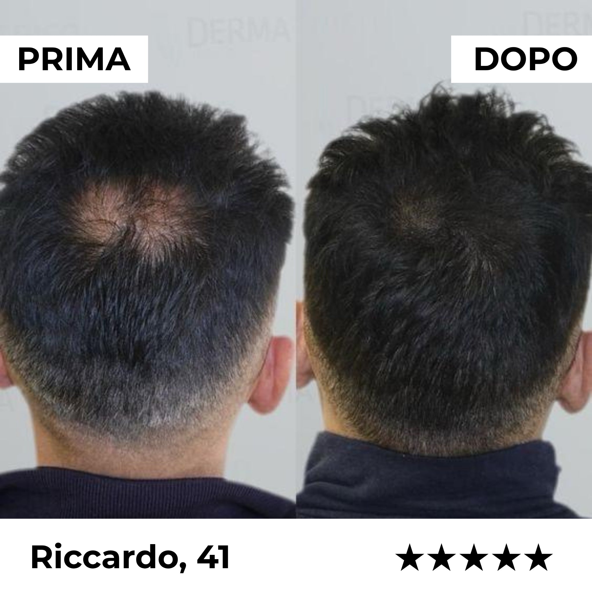 System Mikroinfuzji Kapilarnej Firmelià PRO®